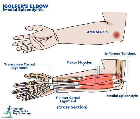 Pain In Elbow Joint