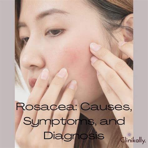 Demodex Mites and Rosacea: Connection and How to Treat It | Clinikally
