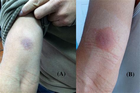 Fixed Drug Reaction at Gary Norris blog