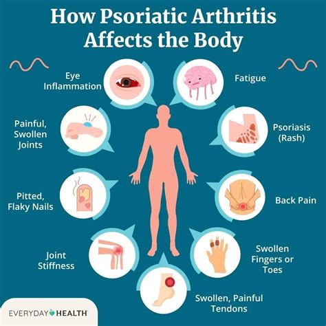 Psoriatic Arthritis - ArthurCare