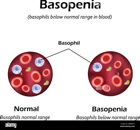Basophils below the normal range in the blood. Basopenia. Infographics. Vector illustration ...