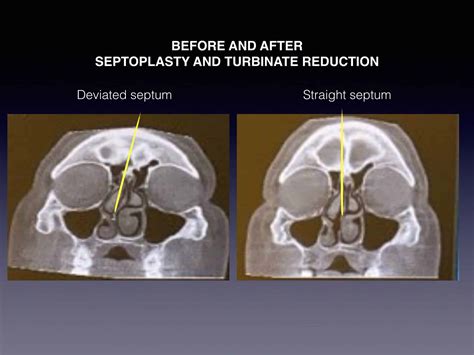 Septoplasty And Turbinate Reduction