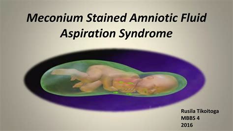 Meconium stained amniotic fluid aspiration syndrome | PPTX