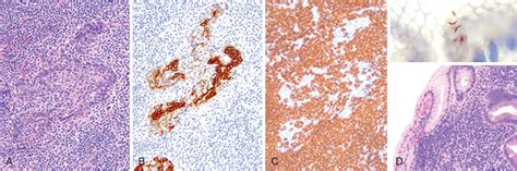 Marginal Zone Lymphomas (Extranodal/Malt, Splenic, and Nodal) - Clinical Tree