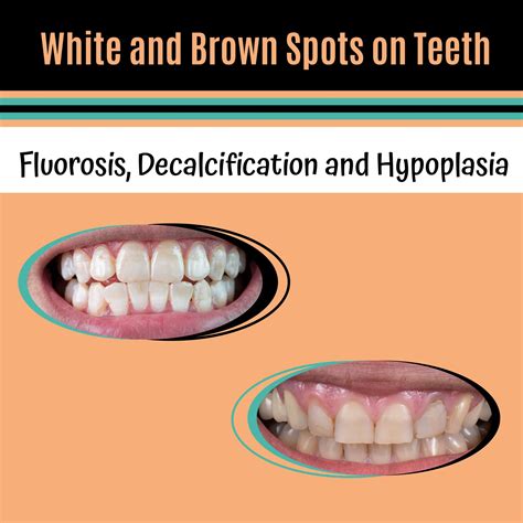 Teeth With Brown Spots _ Brown Stains On Teeth – PPWBP