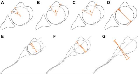 Arthroscopic retrograde disimpaction of reverse Hill-Sachs lesions in acute posterior shoulder ...
