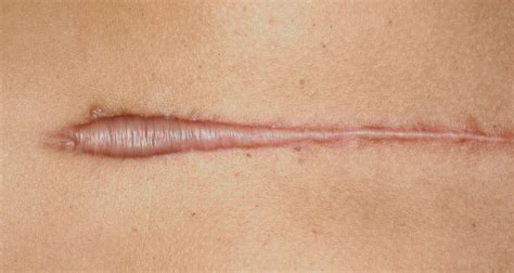 Keloid Scars: What They Look Like and When to See a Doctor (Photo Guide) - Health Service Navigator