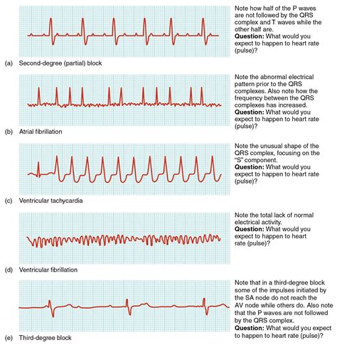 Common ECG Abnormalities Diagram: A Detailed Guide - Anatomy Note