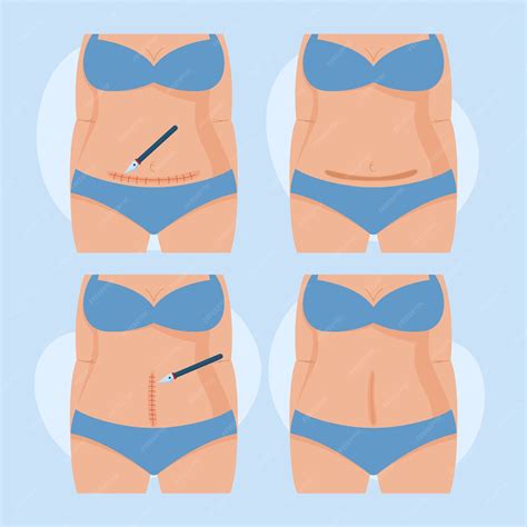 Hand drawn flat design cesarean section | Free Vector