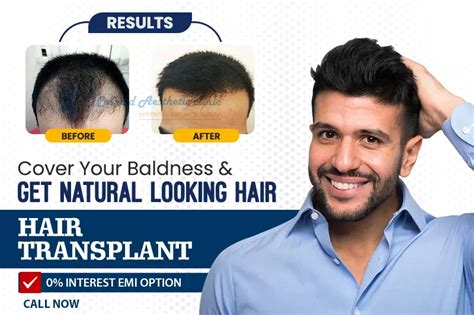 Best Hair Transplant in Thane, Mira Road | Best Hair Transplant clinic