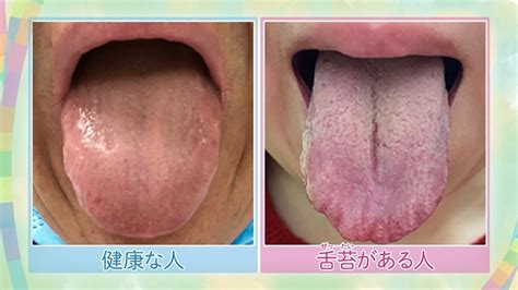口臭の原因や検査方法、口臭ケアについて解説 | NHK健康チャンネル