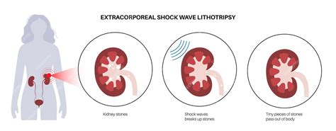 Lithotripsy Procedure 的图像结果