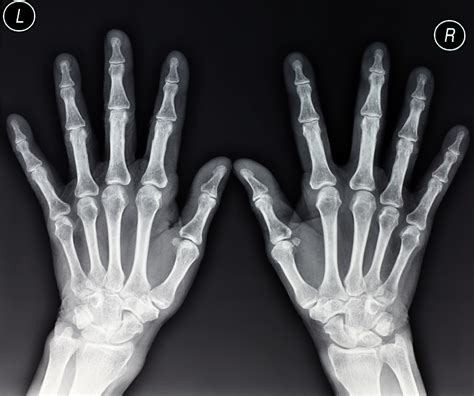 The Importance Of Radiopaque Markers In Digital X-Ray