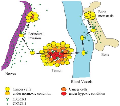 Fractalkine/CX3CL1 in Neoplastic Processes