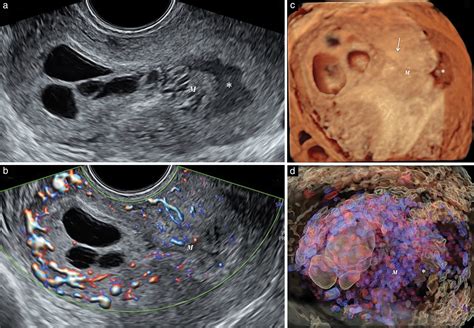 HDlive Flow with HDlive silhouette mode in diagnosis of molar pregnancy ...