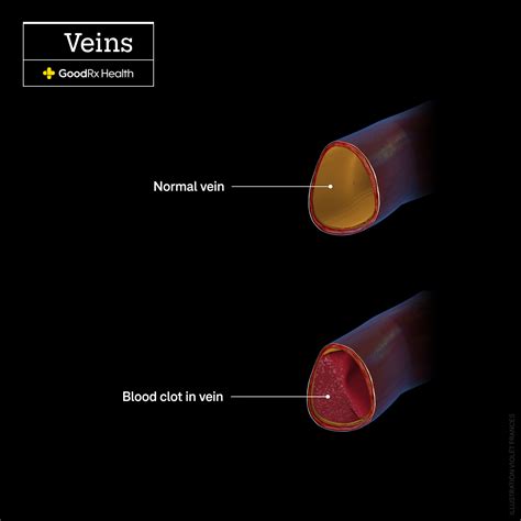 What Does a Blood Clot Feel Like? - GoodRx