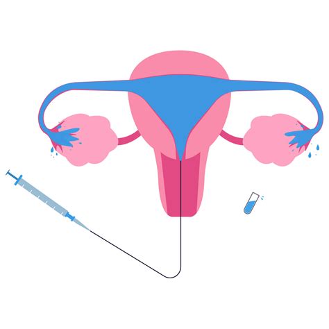 What to Expect from a Hysterosalpingogram (HSG) Procedure – Homedoc