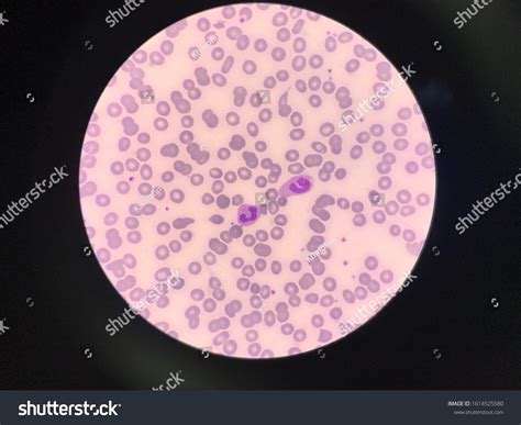 Band Vs Segmented Neutrophils