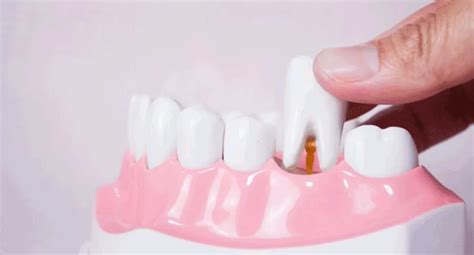 Image result for Getting Tooth Removed