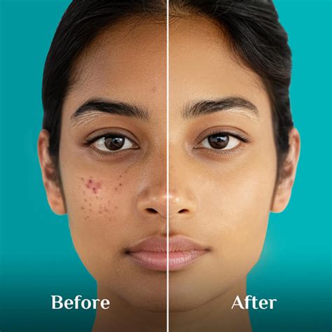 Buy 10% Niacinamide Face Serum For Acne Marks Online