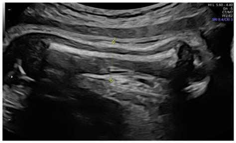 Accuracy of Fetal Biacromial Diameter and Derived Ultrasonographic ...