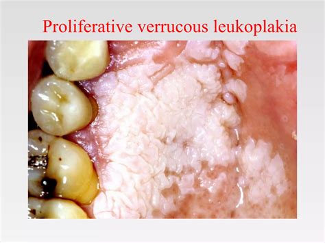 Proliferative Verrucous Leukoplakia