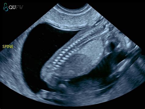 Nuchal Translucency / Early Anatomy / Pre-eclampsia Screening - QUFW
