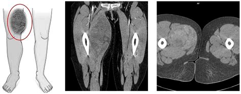 Myxoid Liposarcoma of the Thigh in Early Puerperium—Rare Case Report ...