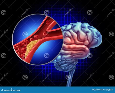 Transient Ischemic Attack On Blue Stock Photo | CartoonDealer.com #254258070