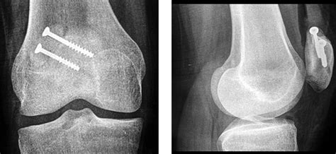 Bipartite Patella - Pediatrics - Orthobullets