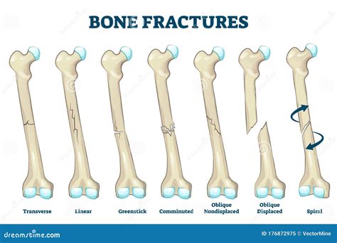 Pathological Fracture