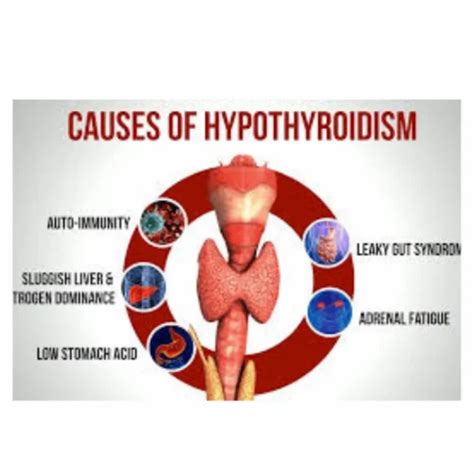 Image result for hyperthyroidism