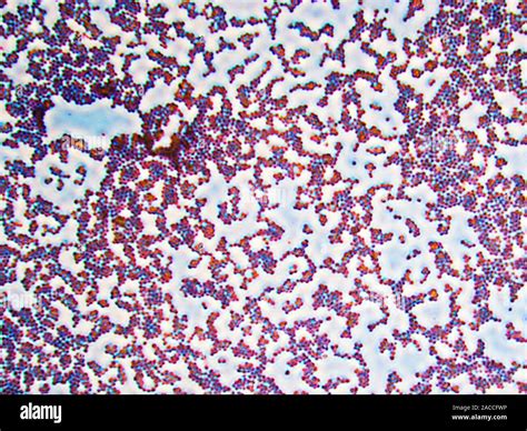 Gram Positive Cocci Clumps