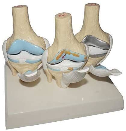 Buy Set Pivot Knee models, arthritic pathology anatomical model Knee ...