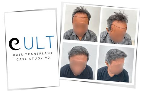 Hair Transplant Case Study 90 | Cult Aesthetics