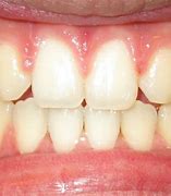 incisors 的图像结果