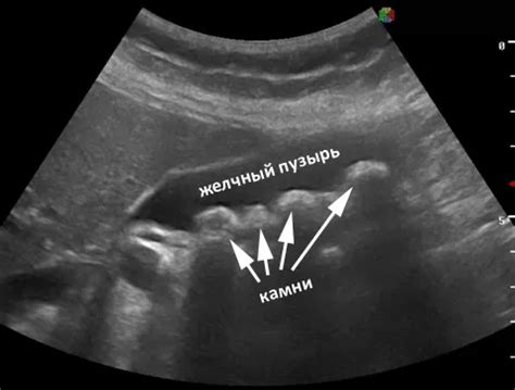Желчнокаменная болезнь: причины, симптомы и лечение ЖКБ | GMS Hospital