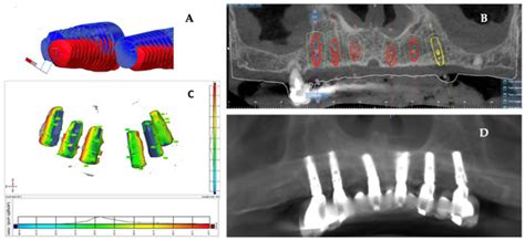 Accuracy of DICOM–DICOM vs. DICOM–STL Protocols in Computer-Guided ...