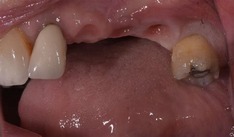 Implant Retained Bridge - Dr James Millar Dental Implant Surgeon
