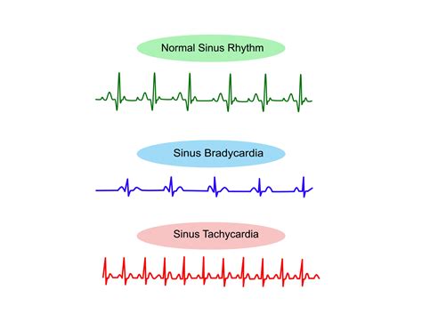 Sinus Rhythms Explained: A Comprehensive Guide to ECG Interpretation