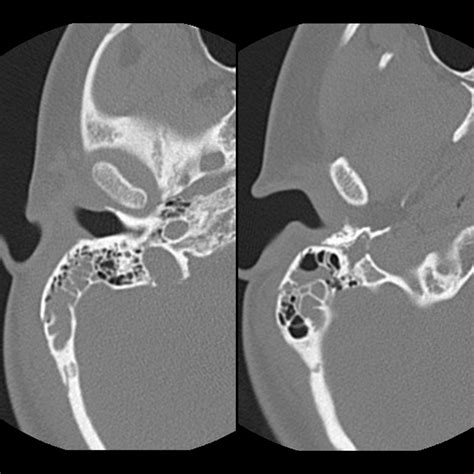 Pediatric Mastoid Fracture | Pediatric Radiology Reference Article | Pediatric Imaging ...