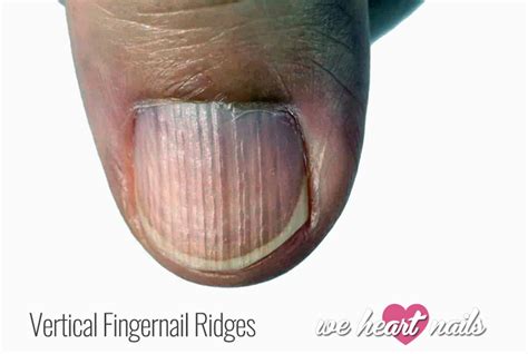 Vertical Ridges on Nails - Causes, Prevention & Treatment