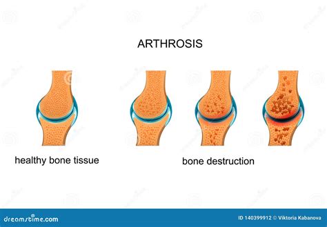 What Is Arthrosis