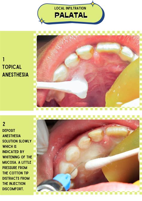 Local Anesthesia Examples 的图像结果
