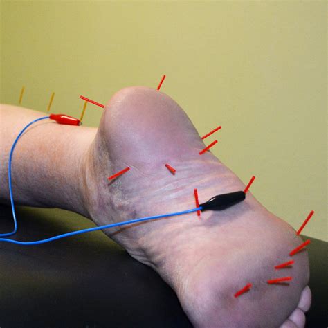 Dry Needling Services | Pintler Physical Therapy | Anaconda, MT