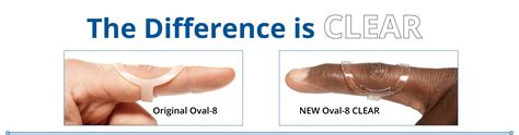 What Is An Oval 8 Finger Splint at Finn Gottshall blog