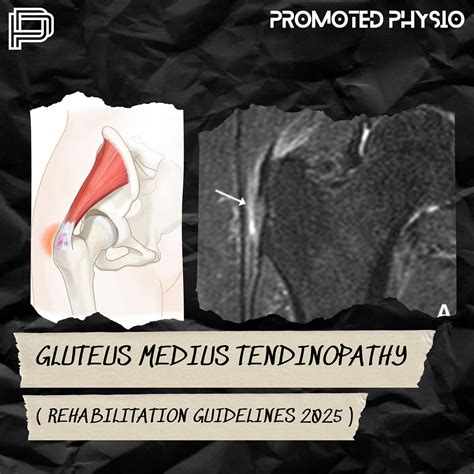 Promoted Physio (@promotedphysio) • Instagram photos and videos