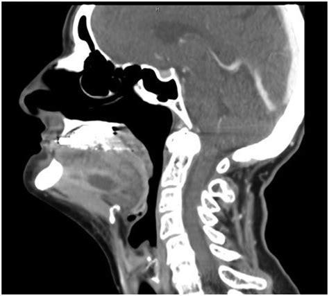 Trismus, the first symptom in a challenging diagnosis of Tetanus | BMJ Case Reports