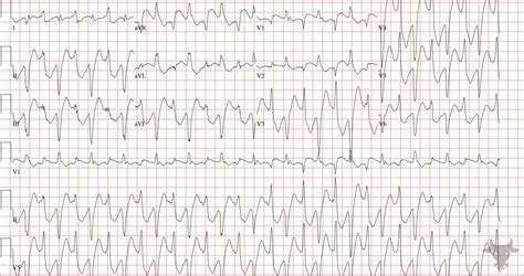 Digoxin Toxicity | ECG Stampede