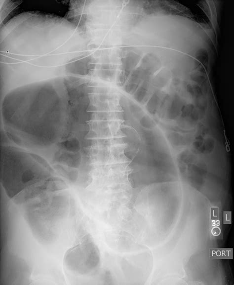 Coffee Bean Sign | Published in Journal of Brown Hospital Medicine